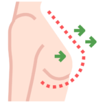 breast augmentation